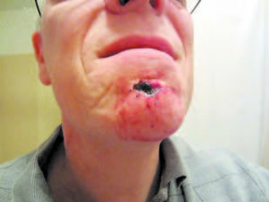 OUCH! Even using an expensive razor can prove to be slightly dangerous to oneâ€™s face as columnist Peter Lewis personally discovered. â€œItâ€™s not as bad as it looks,â€ said. 